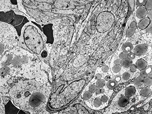 F,49y. | hemangioblastoma - brain